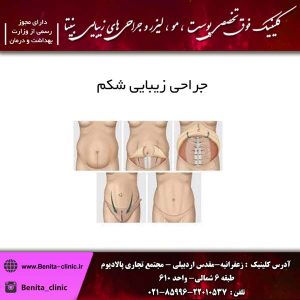 جراحی زیبایی شکم