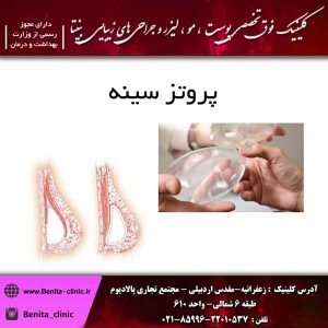 پروتز سینه