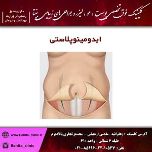 ابدومینوپلاستی