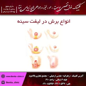 انواع برش در لیفت سینه