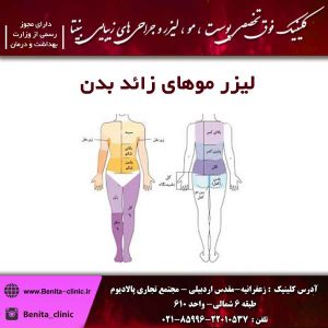 لیزر موهای زائد بدن