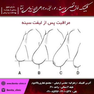مراقبت پس از لیفت سینه