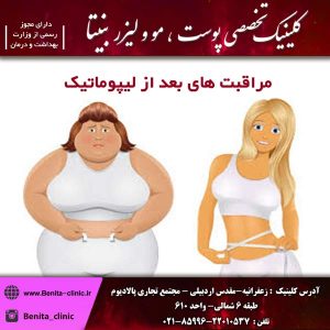 مراقبت-های-بعد-از-لیپوماتیک