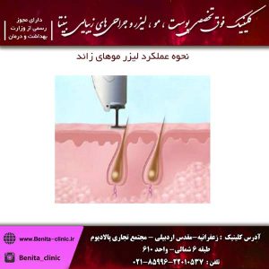 نحوه عملکرد لیزر موهای زائد
