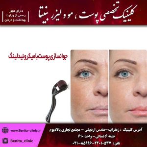 جوانسازی پوست با میکرونیدلینگ 