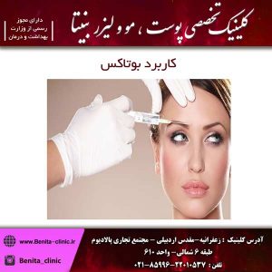 کاربرد بوتاکس 