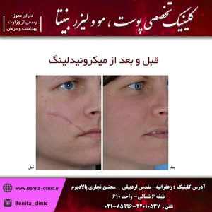 قبل و بعد از میکرونیدلینگ