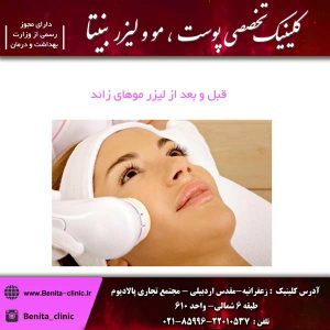 قبل و بعد از لیزر موهای زائد
