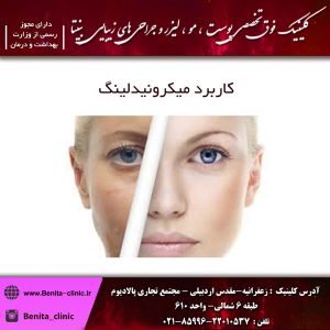 کاربرد میکرونیدلینگ